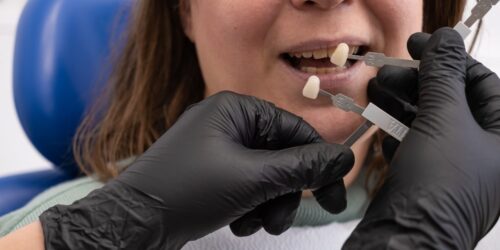 Tooth Replacement with Single Tooth Implants or Bridges in Baton Rouge, Louisiana