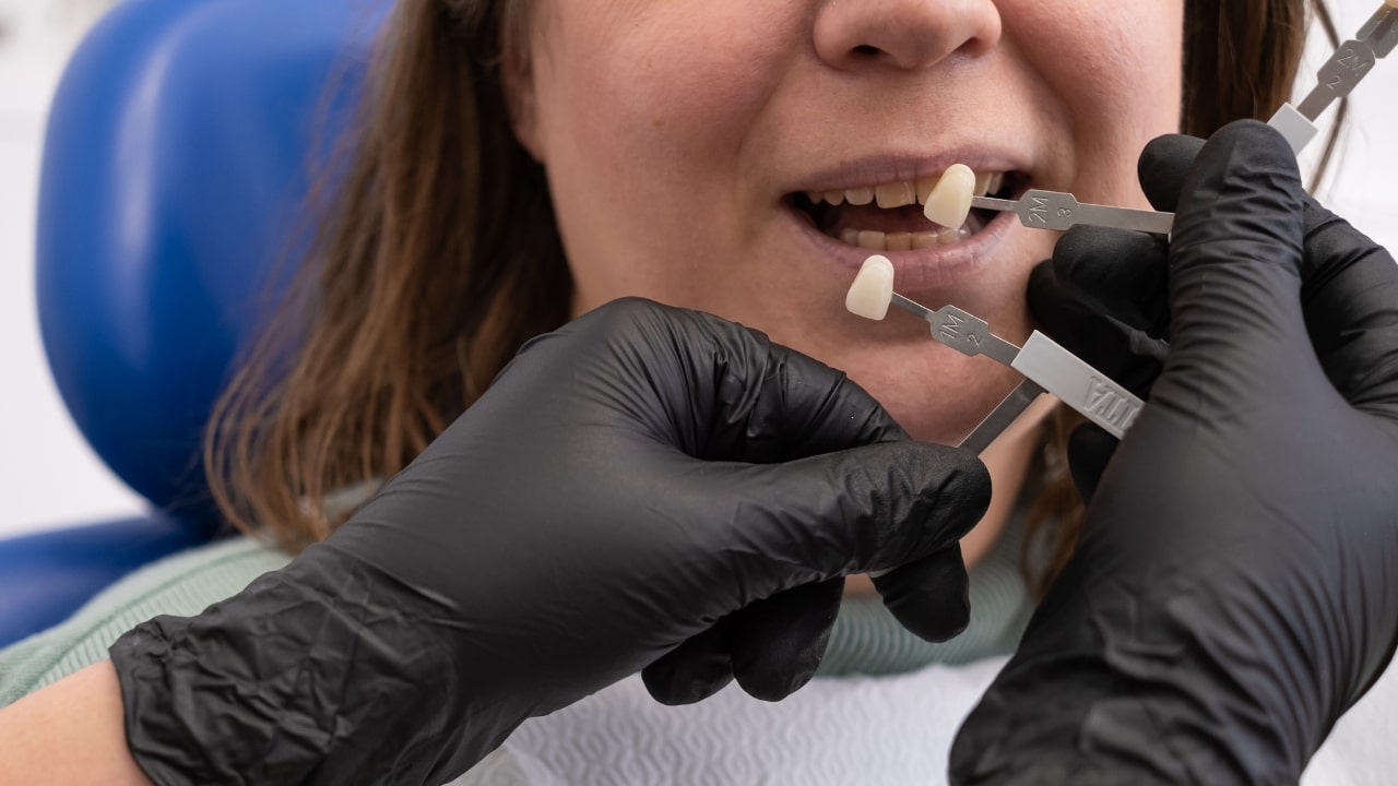 You are currently viewing Tooth Replacement with Single Tooth Implants or Bridges in Baton Rouge, Louisiana