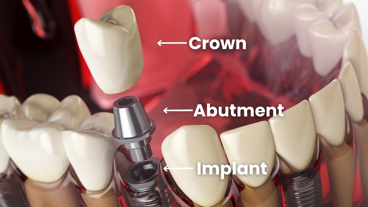 You are currently viewing The 3 Parts of a Dental Implant Explained