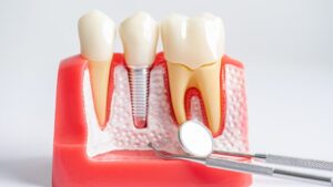 Top 5 Most Frequently Asked Questions about Dental Implants