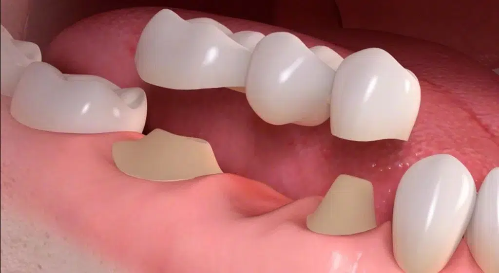 Single tooth Implant or bridges