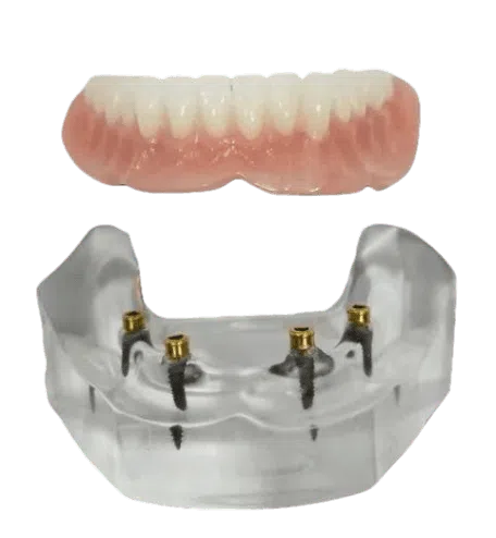 implant dentures near you