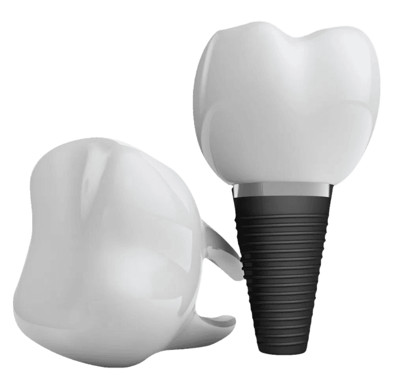 single tooth implants or bridges in baton rouge