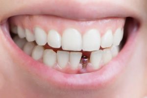 single tooth implants the best solution for replacing a missing tooth
