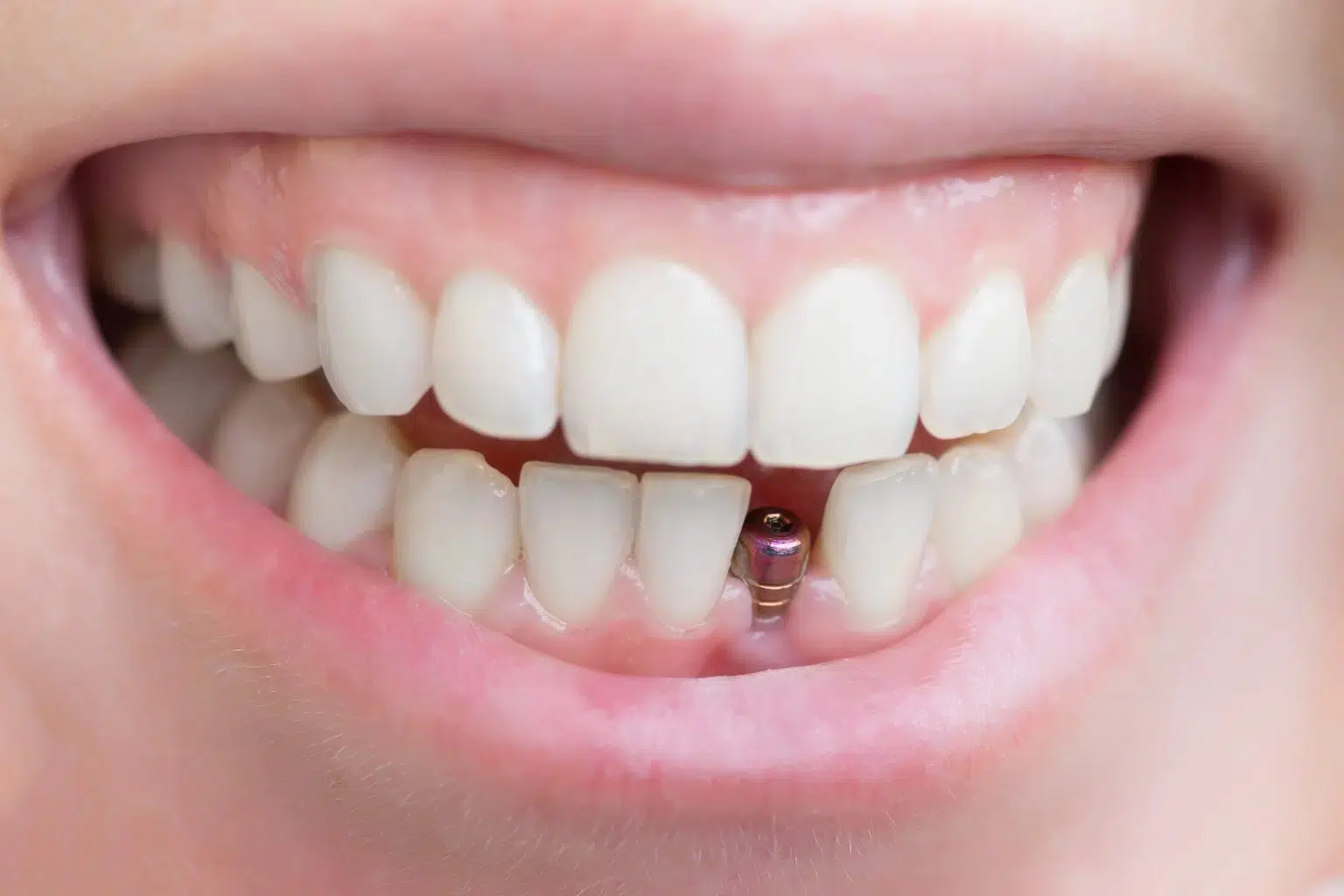 Read more about the article Single Tooth Implants: The Best Solution for Replacing a Missing Tooth?