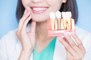 Implant Dentures in Baton Rouge