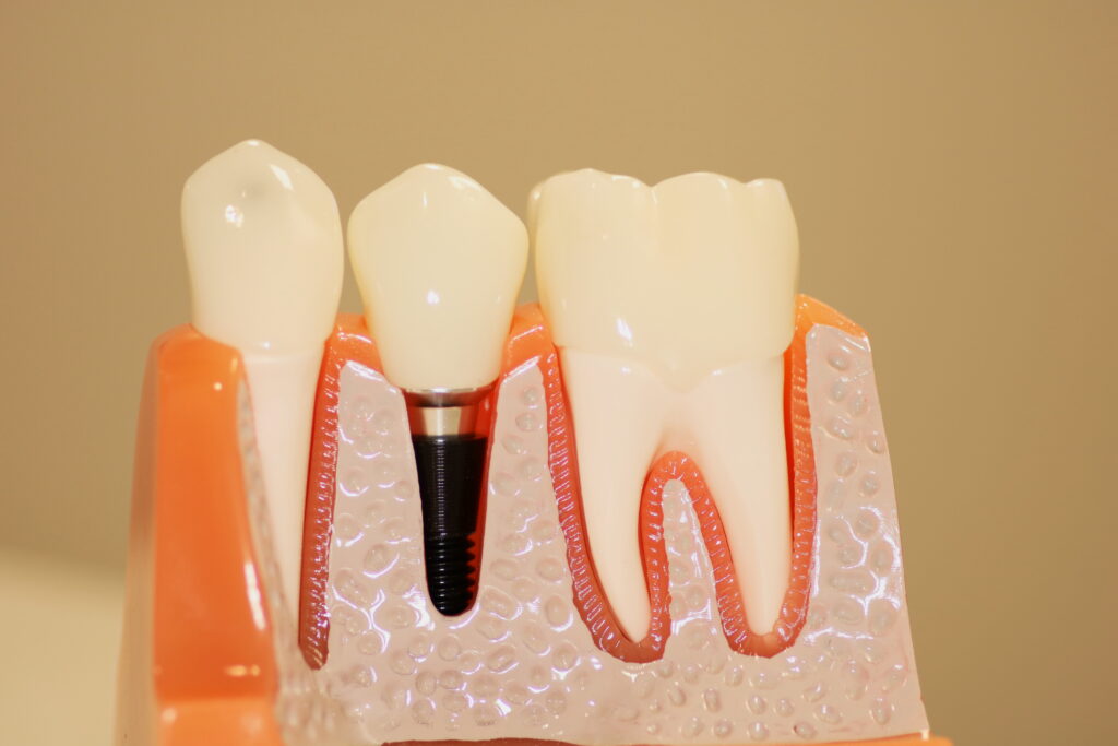 dental implant part - crown and abutment 