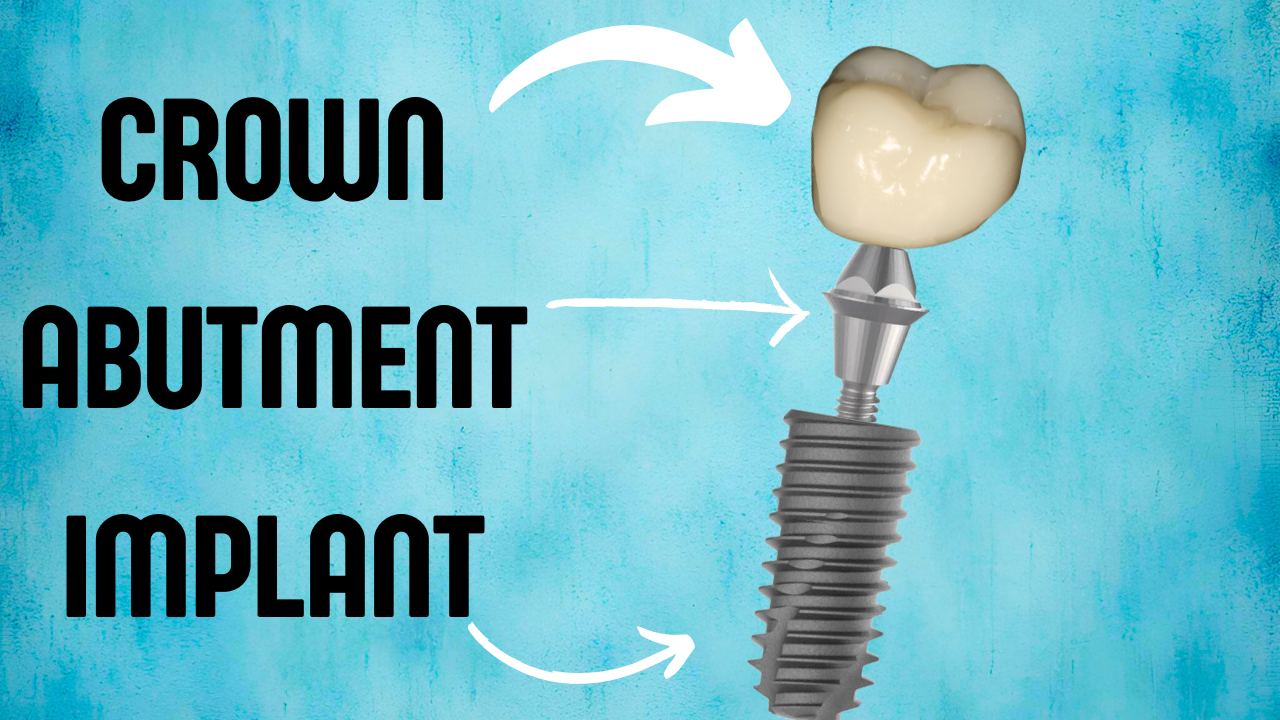 Read more about the article Dental Implant Parts – Crown, Abutment, Implant