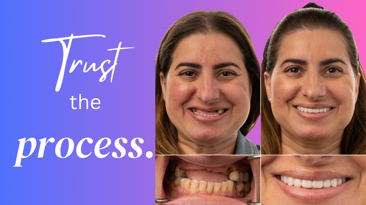 Read more about the article The 7 Step All-on-4 Dental Implant Process For Your Incredible New Smile