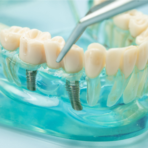 You are currently viewing Cost of Full Mouth Dental Implants in Baton Rouge, LA