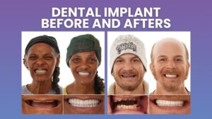 Baton Rouge Dental Implant Before and Afters